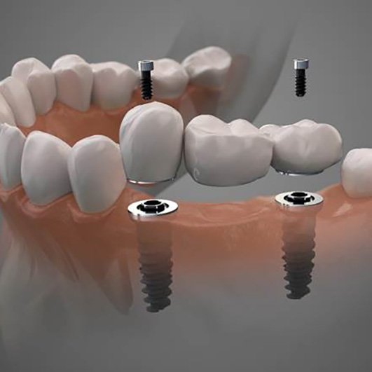 Digital illustration of implant dental bridge in Barnegat
