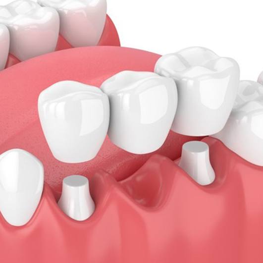 dental bridge replacing one missing tooth 