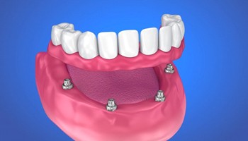 full denture being supported by four dental implants