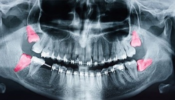X-ray showing four wisdom teeth