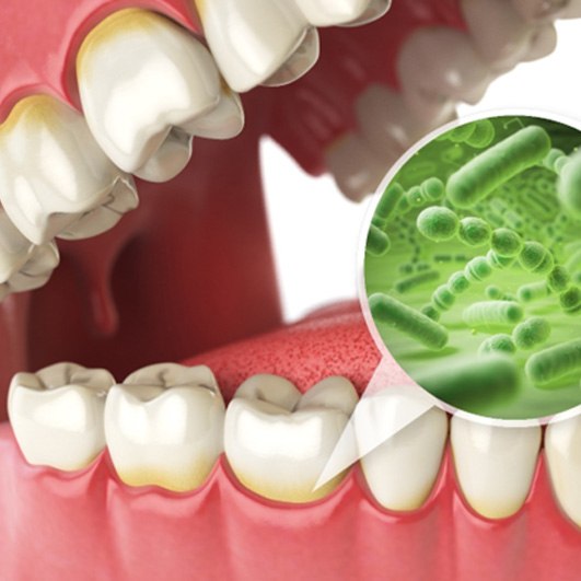 A closeup of harmful bacteria near the gums