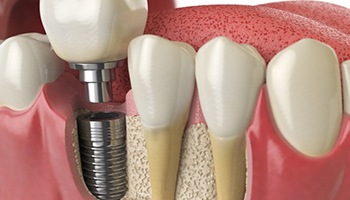 a 3 D illustration of dental implant abutment undergoing osseointegration