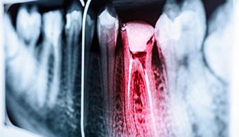 X-ray of a dental emergency in Barnegat