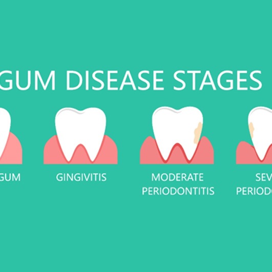 illustration of gum disease for tooth extractions in Barnegat  