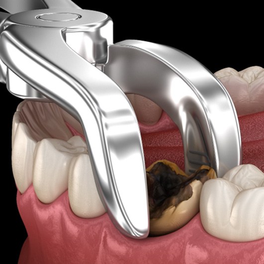 illustration of decayed tooth extraction in Barnegat 