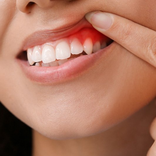 A woman revealing her infected gums