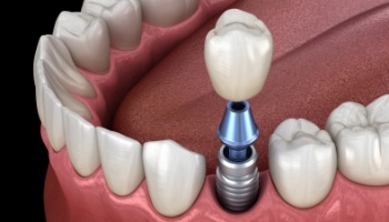 Animated dental implant supported dental crown