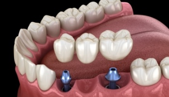 Animated dental implant supported fixed bridge