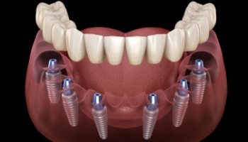 Animated dental implant supported denture