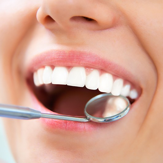 Dentist checking tooth colored filling during preventive dentistry visit