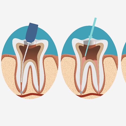 satisfied man after root canal therapy in Barnegat 