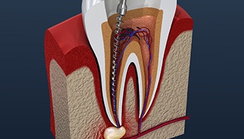 Illustration of a root canal treatment in Barnegat, NJ