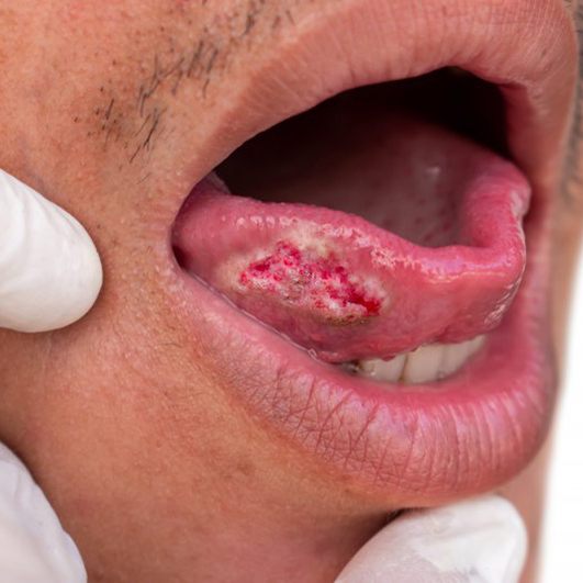 Close up of a lump on a patient’s tongue
