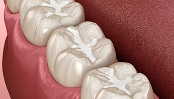 An illustration of dental sealant being applied to a child's molar