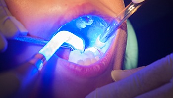 Dentist in Barnegat applying dental sealants to a young patient's teeth