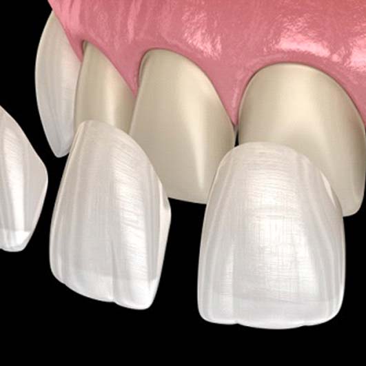 several veneers being placed over a row of upper front teeth