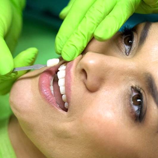 cosmetic dentist in Barnegat placing a veneer on a patient’s tooth