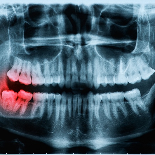 X-ray of wisdom tooth extraction in Barnegat  