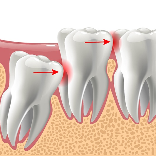 illustration of problematic wisdom tooth extraction in Barnegat  