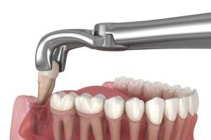 Illustration of dental forceps removing wisdom tooth