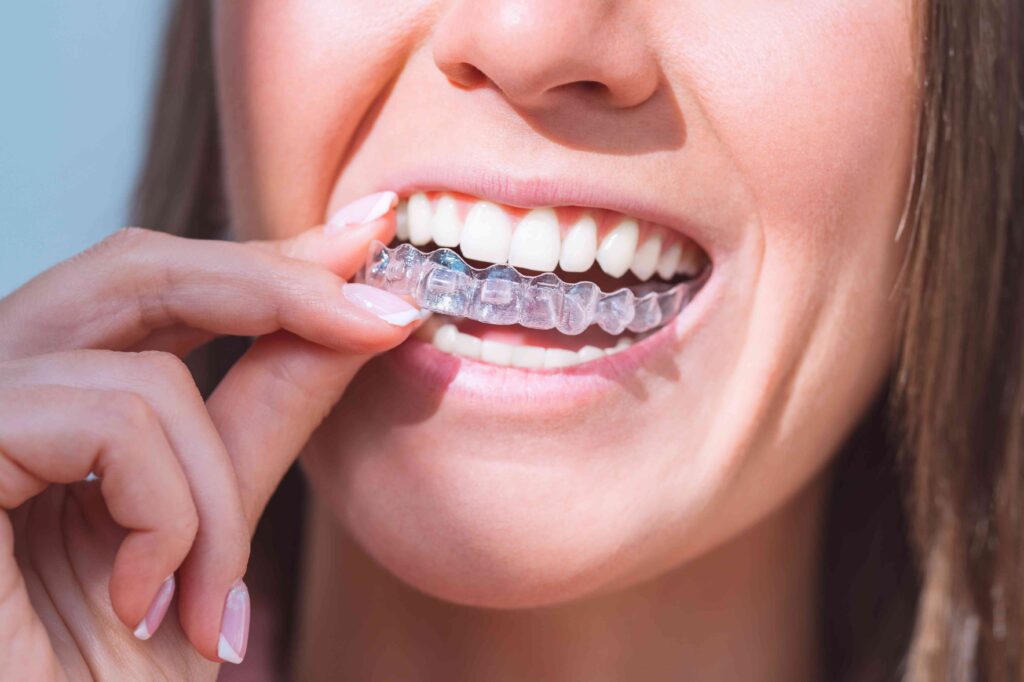 Woman putting in Invisalign aligner