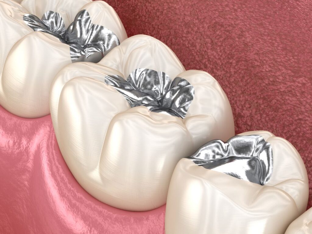 An illustration of teeth with amalgam metal fillings