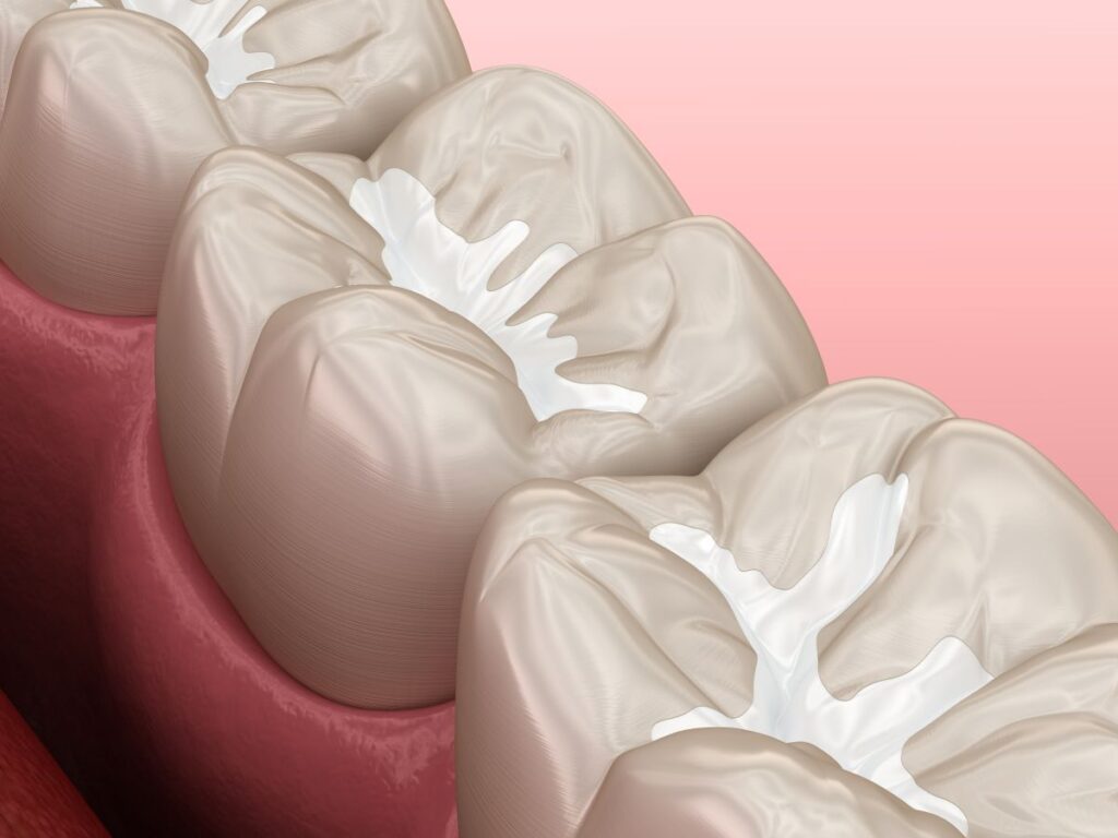 A CGI image of teeth with dental sealants